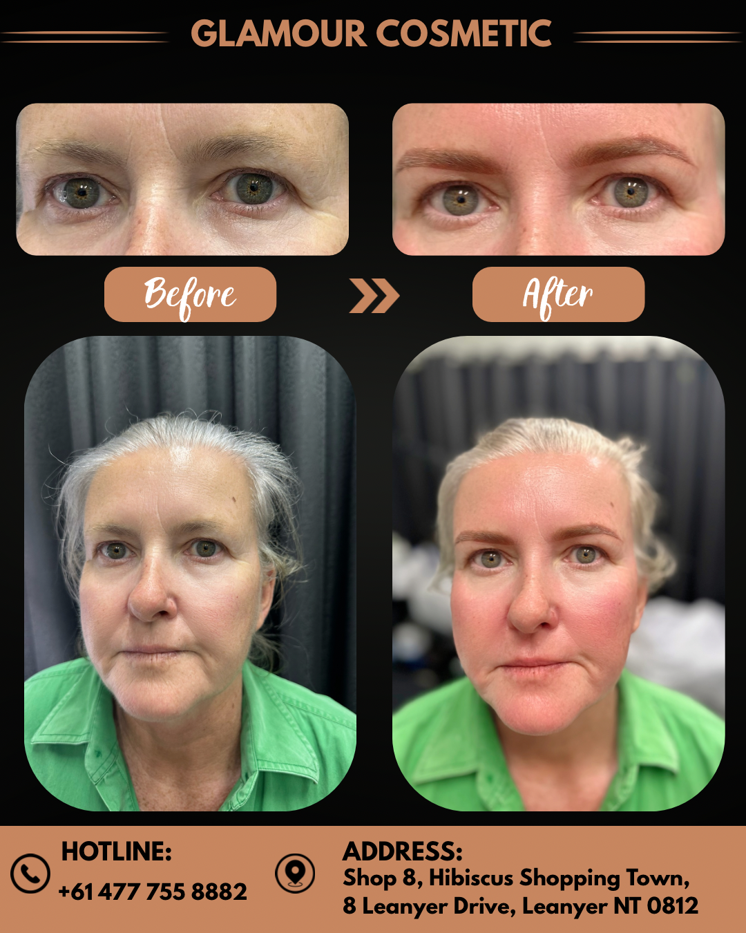 Complete Facial Transformation - Brows